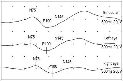 Analysis of visual evoked potentials in patients with neurofibromatosis type 1: new concepts